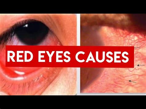 Uveitis Vs Conjunctivitis