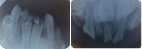 A Anterior Mandibular Periapical Radiography And B Anterior Maxillary