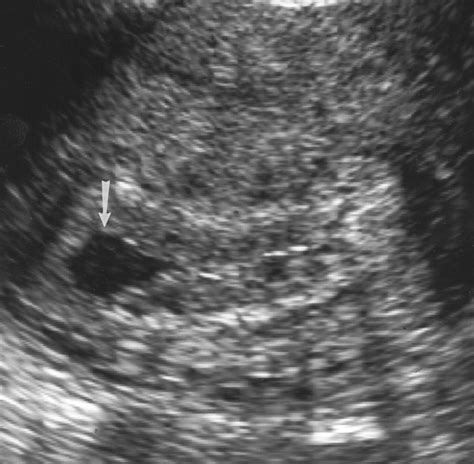 Sonography Of Obstetric And Gynecologic Emergencies Part I Obstetric