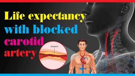 Life Expectancy With Blocked Carotid Artery Reflective Thoughts