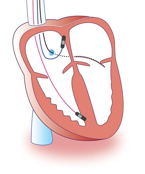 Heart Failure Ecg Echo