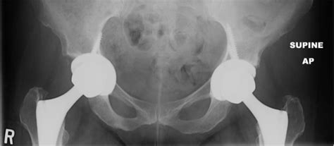 Acetabular Reconstruction With The Medial Protrusio Technique For