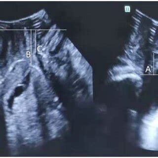 Transperineal Ultrasound Image In The Mid Sagittal Plane Demonstrating