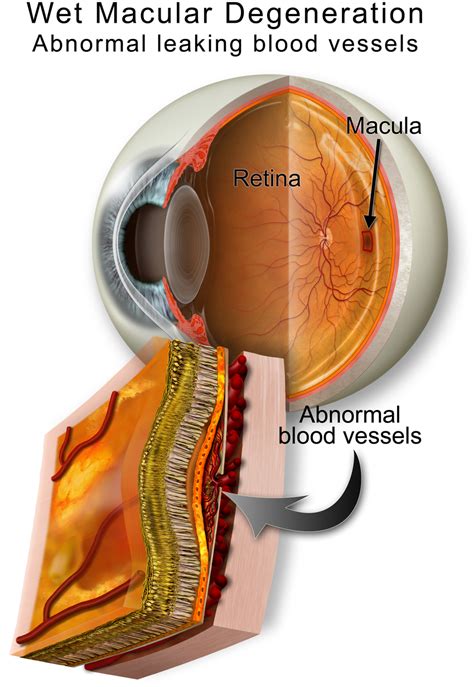 Macular Degeneration Treatment | Eye Specialist Institute | Gold Coast