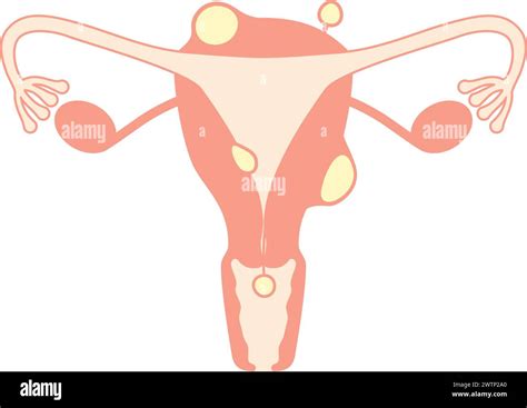 Diagrammatic Illustration Of Uterine Fibroids Anatomy Of The Uterus And Ovaries Vector