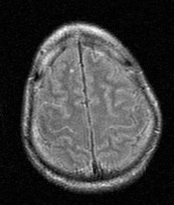 Diffuse Axonal Injury-MRI - Sumer's Radiology Blog