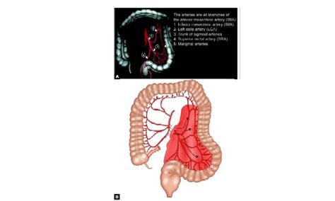 Laparoscopic Sigmoidectomy Surgery