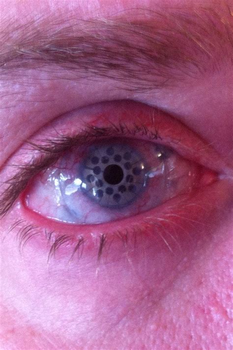 What An Eye Looks Like Healed After Corneal Transplant Surgery R Pics