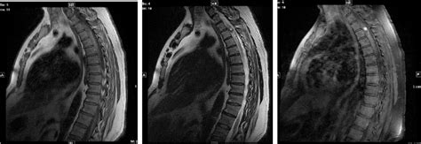 Figure From Intramedullary Spinal Cord Hemangioma A Rare Case Report