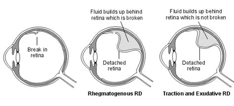 Back To Basics Retinal Detachment Sydney Ophthalmic Specialists