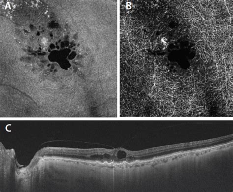 Ss Octa In Rap Lesions Retina Today