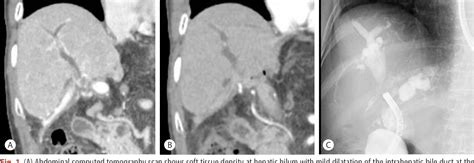 Figure 1 From A Case Of Direct Peroral Cholangioscopy Guided