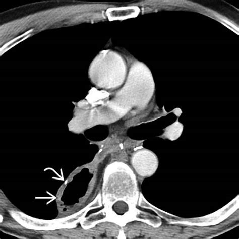 Esophagectomy Ivor Lewis And Other Procedures Clinical Gate