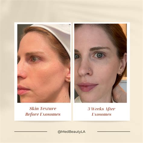 Microneedling Exosomes Before And After Photos Medbeautyla