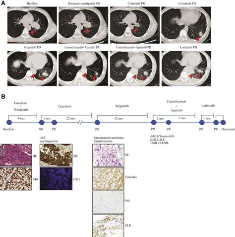 Clinical Benefit From A Combination Of Brigatinib And Camrelizumab In