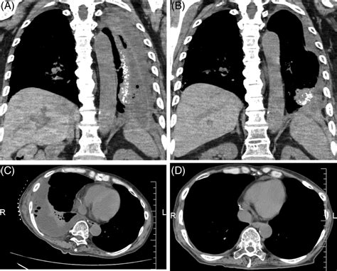 Negative Pressure Wound Therapy With Instillation Without Open‐window