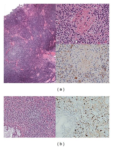 Histological findings in a typical case of orbital IgG4-related ...