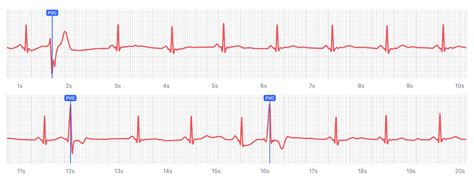 What Premature Ventricular Contraction Pvc Looks Like On Your Watch