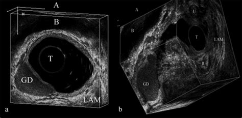 Evaluation Of Vaginal Cysts And Masses By 3‐dimensional Endovaginal And