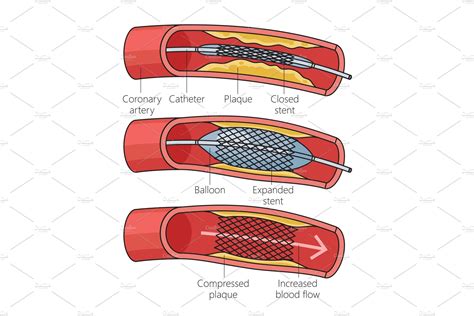 Diagram coronary stent placement | Creative Market