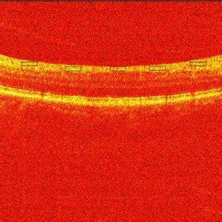 Sample of an OCT image of a normal retina | Download Scientific Diagram