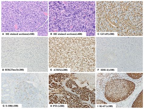 Frontiers Intracranial Metastases Originating From Pediatric Primary