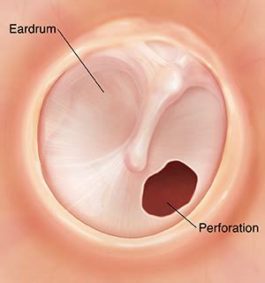 Ruptured Eardrum | Saint Luke's Health System