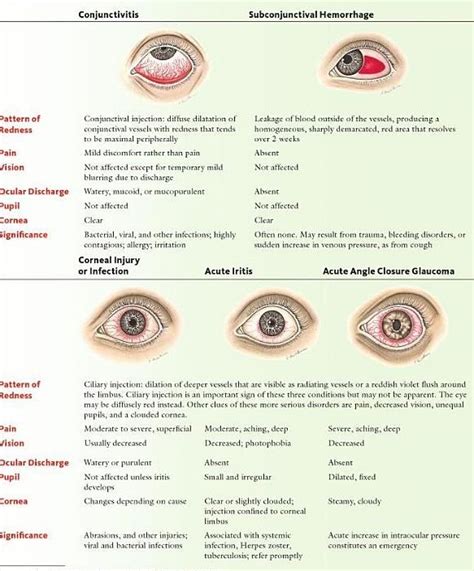 Red Eye Ddx Nurse Optometry Education Optometric