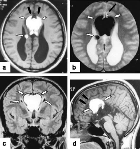 Axial A Coronal C And Mid Sagittal D T1 Weighted Spin Echo And