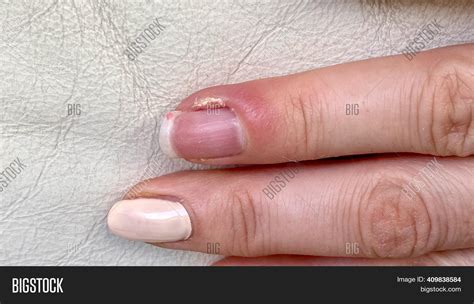 Paronychia Swollen Finger With Fingernail Bed Inflammation 46 Off