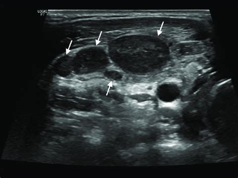 Enlarged Lymph Nodes Ultrasound