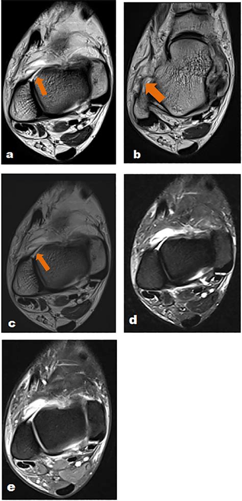 A 42-year-old man with recurring right ankle sprain and complete ATFL ...