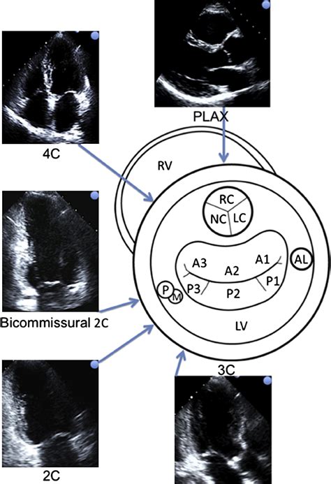 Anatomy Of The Mitral Valve Apparatus Cardiology Clinics