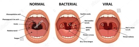 Tonsils Causes Symptoms And Treatment