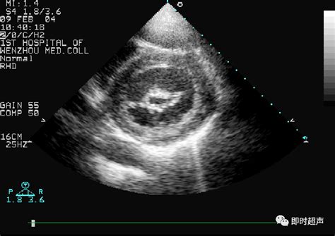 心脏瓣膜病超声诊断二尖瓣