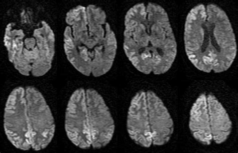 Dr Balaji Anvekar FRCR: Hyperammonemic Encephalopathy