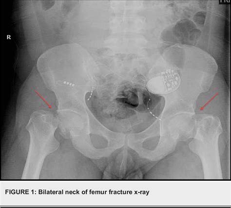 Figure From Simultaneous Bilateral Neck Of Femur Fracture After