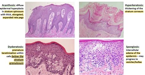 Acanthosis Histology