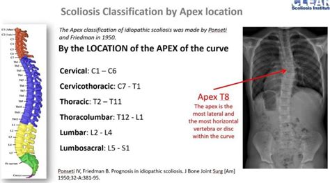 How Is Scoliosis Classified