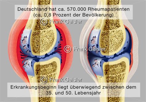 Gelenke Mit Rheumatoide Arthritis Rheumapatienten In Deutschland