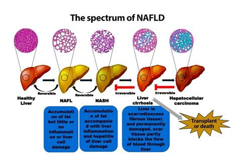 Stages Of Fatty Liver Disease Progress And Whether It Is Reversible Or Download Scientific