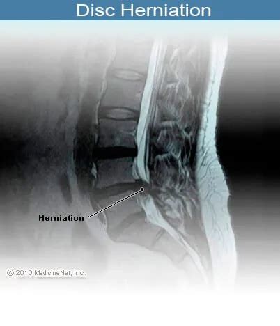 Nerve Pain: Treatment L5 Nerve Pain