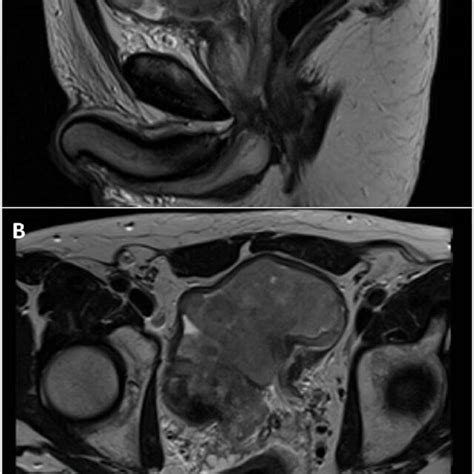 Mri Pelvis Demonstrating Leiomyosarcoma A Sagittal Image B Axial