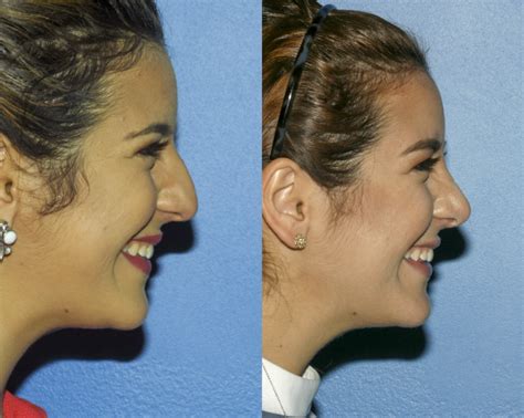 Before After Gallery Rhinoplasty Best Rhinoplasty And Nose Job