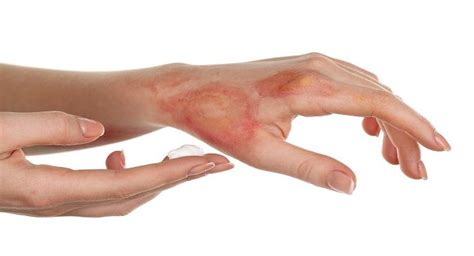 Understanding a Burn: Symptoms, Types, and Treatments – Hello Med