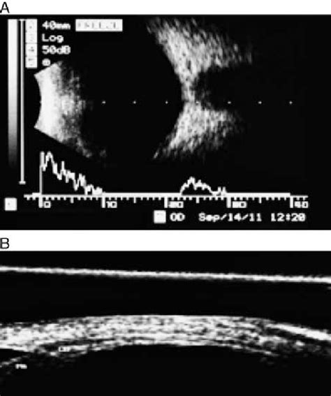 A B Scan Ultrasonography Of The Right Eye Of Patient Month After