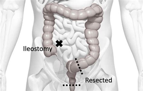 Ultra Low Anterior Resection Richard Hughes Jones