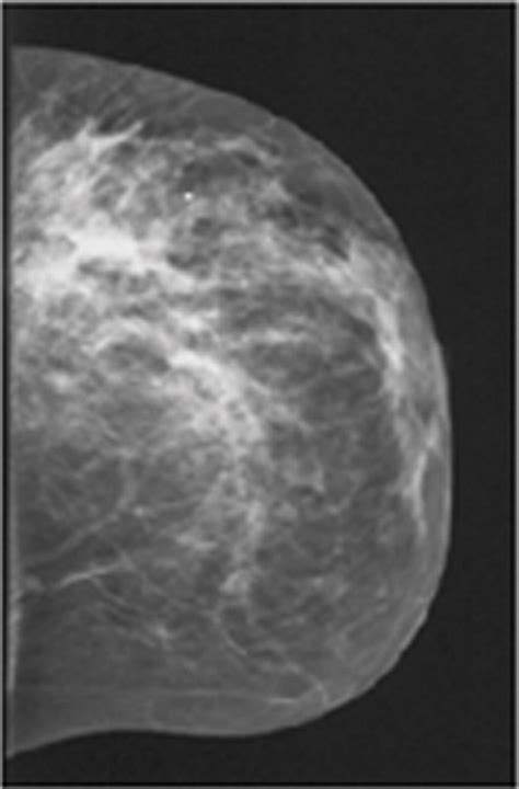 Dynamic Diffuse Optical Tomography For Monitoring Neoadjuvant