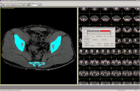 Semi Automatic Threshold Segmentation Of Skeletons In 3d Doctortm