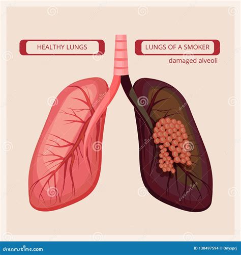 Pulmones Del Fumador Im Genes Infographic M Dicas Del Da O Del Humo De